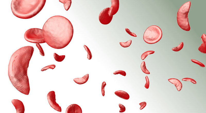 Sickled blood cells (illustration)